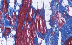 From mutation to arrhythmia: desmosomal protein breakdown as an underlying mechanism of cardiac disease