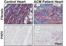 From mutation to arrhythmia: desmosomal protein breakdown as an underlying mechanism of cardiac disease 2