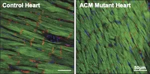 From mutation to arrhythmia: desmosomal protein breakdown as an underlying mechanism of cardiac disease 3