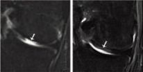 From nose to knee: Engineered cartilage regenerates joints