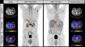 Ga-68 FAPI PET improves detection and staging of pancreatic cancer