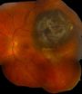 Gene in eye melanomas linked to good prognosis 