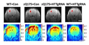 Gene therapy in early stages of Huntington's disease may slow down symptom progression