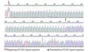 Genetic diagnosis can rule out a suspected Huntingtons chorea patient