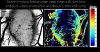 Genetic form of anemia offers new avenue to treating drug-resistant tumors