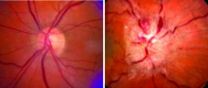 Glaucoma drug helps women with blinding disorder linked to obesity