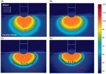 Greater effectiveness in the treatment of arrhythmia with radio frequency energy and catheterization