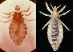 Head and body lice appear to be the same species, genetic study finds