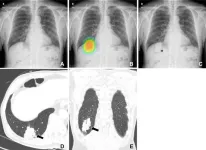 High accuracy AI improves lung cancer detection