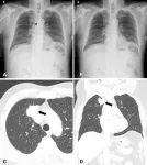 High accuracy AI improves lung cancer detection 2