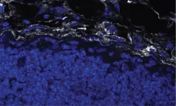 How tumor stiffness alters immune cell behavior to escape destruction