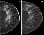 Huge study finds tomosynthesis better at breast cancer detection 2