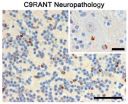 Identification of abnormal protein may help diagnose, treat ALS and frontotemporal dementia