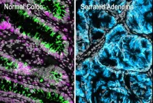 Identifying the initial steps in colorectal cancer formation