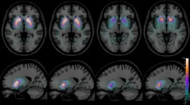 Imaging of a living brain can help clearly differentiate between two types of dementia