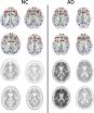 Imaging shows brain connection breakdown in early Alzheimers disease