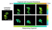 Improving breast cancer chemo by testing patients tumors in a dish