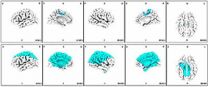 In schizophrenia patients, auditory cues sound bigger problems