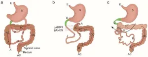 Innovative approaches to the surgical challenges in the management of gastroschisis