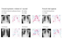 Innovative, highly accurate AI model can estimate lung function just by using chest x-rays