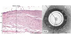 Innovative imaging technique may revolutionize ureteral thermal injury detection