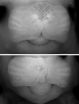 Insights into genetics of cleft lip