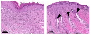 Intestinal parasite could hold key to scar-free wound healing, study suggests