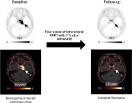 Intraarterial radionuclide therapy safe and effective for advanced meningioma patients