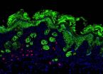 Itching for new help for eczema: Recently identified immune cells possible therapeutic target