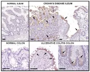 Johns Hopkins researchers develop gut-restricted drug to treat IBD