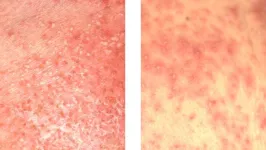 Keeping score: novel method might help differentiate 2 serious skin diseases