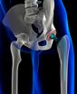 Kershaw, Cutter & Ratinoff Provides Answers for Patients Affected by DePuy Hip Replacement Recall