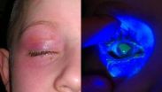 Liquid detergent pods pose risk to childrens eye health