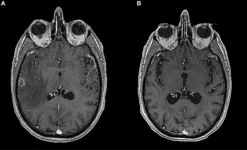 Long-lasting immunotherapy response in stage IV lung cancer with brain metastasis