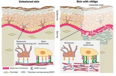 Loss of skin’s pigment-producing cells could be related to basement membrane disruption