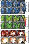 Lung abnormalities seen in children and teens with long COVID