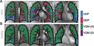 Lung abnormalities seen in children and teens with long COVID 2