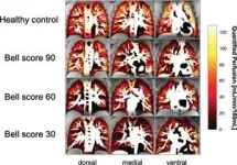 Lung abnormalities seen in children and teens with long COVID 3