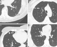 Lung nodules seen in a high percentage of non-smokers