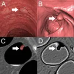 Machine learning method identifies precancerous colon polyps