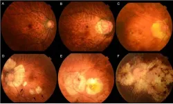 Machine learning sees into the future to prevent sight loss in humans