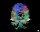 Major advance in MRI allows much faster brain scans