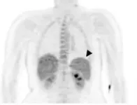 Malaria parasites partiality for the spleen