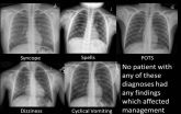 Many chest X-rays in children are unnecessary 2