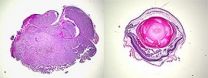 Melanoma of the eye caused by 2 gene mutations