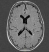 Migraine-associated brain changes not related to impaired cognition