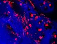 Mini bone marrow model predicts response to blood disorder treatment