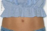 Moderate Tummy Tuck Offered at Milwaukee Area Practice