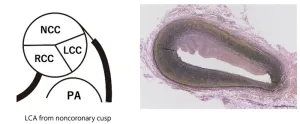 Molecular autopsy sheds light on cause of sudden death of a child with COVID-19