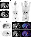 Molecular imaging improves staging and treatment of pancreatic ductal adenocarcinomas